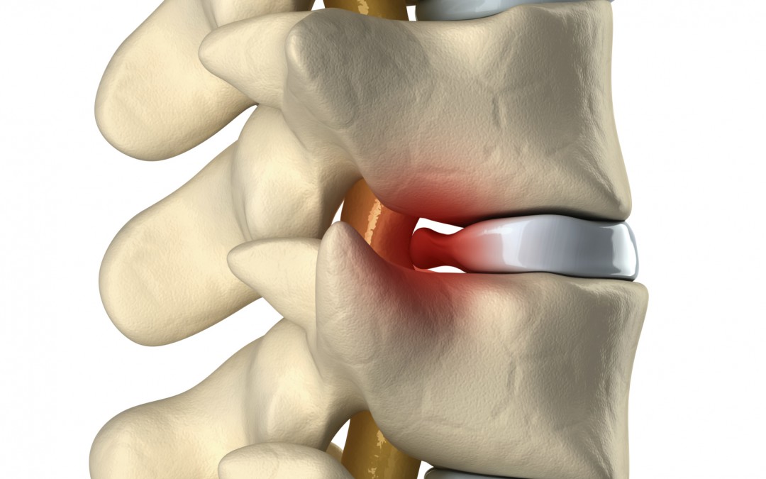 Fast Pain Relief for Sciatica – Limited-Time $59 Offer!