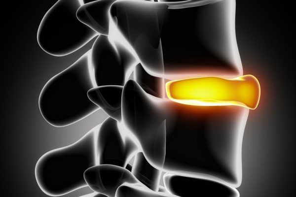 Bulging Disc Treatment Chiropractic Ringwood 1 bulging disc chiropractic care